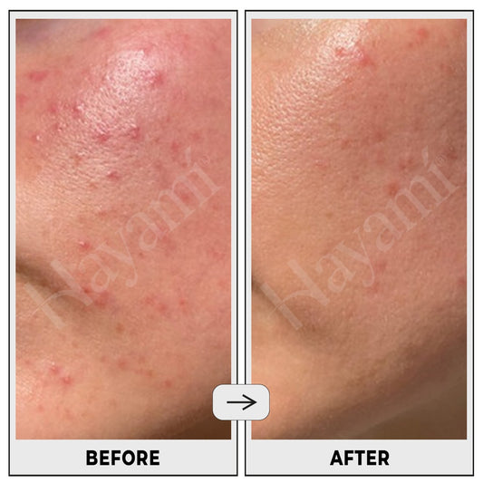 Pimple Clear Serum